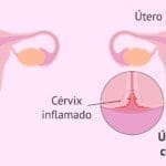 Cervicitis