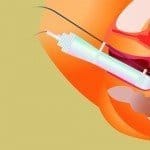 Mejorar la estimulación ovárica