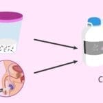 Opciones actuales para preservar la fertilidad en hombres con cáncer