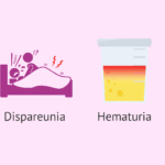 Endometriosis