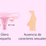 Embarazo con síndrome de Swyer