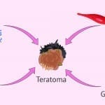 Teratoma