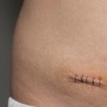 Nuevos marcadores tumorales del cáncer de ovario