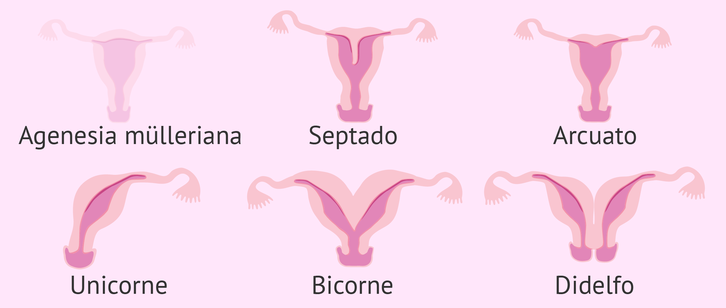 Esterilidad femenina debida a un factor uterino Es uno de los factores que afecta a la esterilidad de la mujer impidiendo quedarse embarazada.