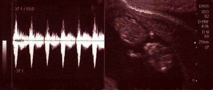 Diez semanas de embarazo. Tu útero ha crecido de manera considerable y comienza a expandirse ocupando prácticamente toda la zona de la pelvis.