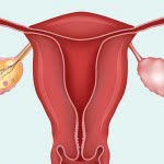 Una mujer da a luz tras un transplante del ovario completo