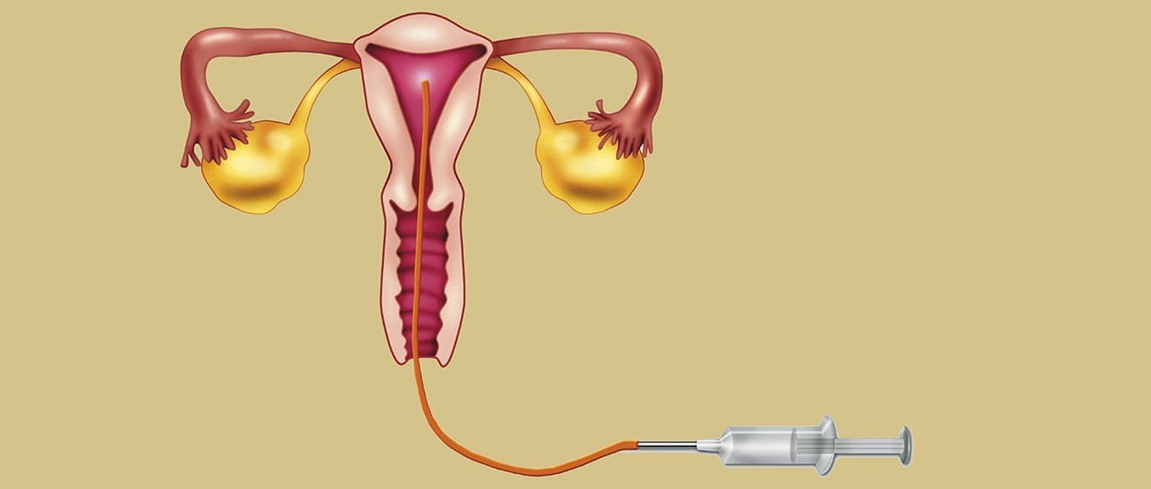 Inseminación intrauterina Inseminación intrauterina