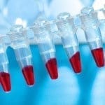 Leucemia linfoblástica del lactante