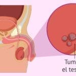 Los hombres en edad fértil son altamente propensos a padecer de cáncer de testículo