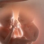 Nace un bebé con un feto dentro