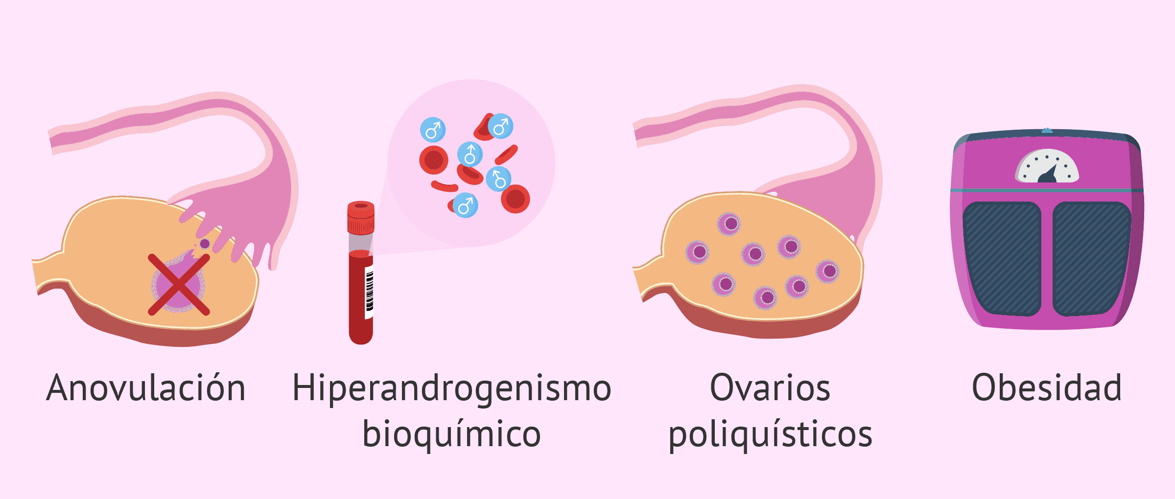 Síndrome de ovario poliquístico