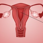 Transplantar útero de madre a hija