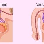 Varicocele