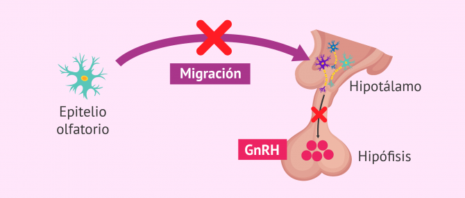 Imagen: Deficiencia de GnRH en el síndrome de Kallmann