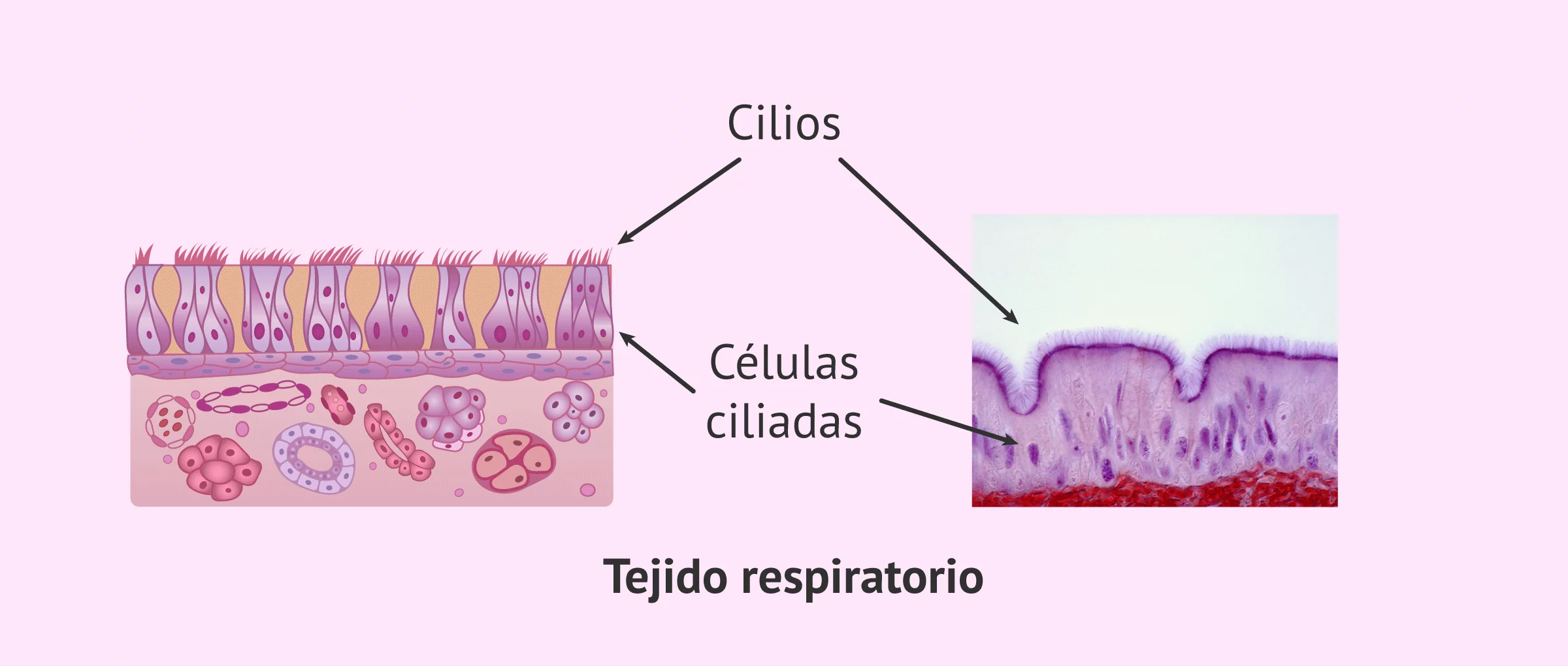 Epitelio respiratorio con cilios y Síndrome de Kartagener