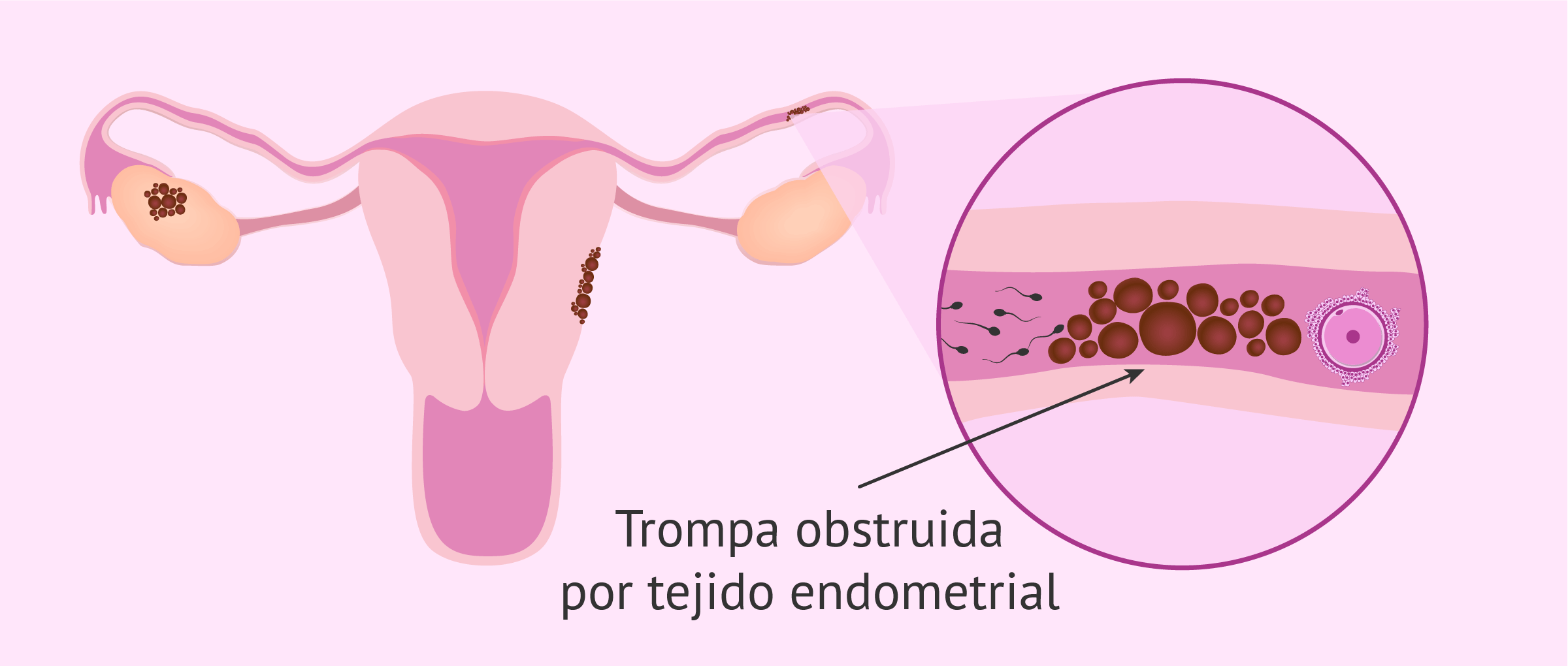 Obstrucción tubárica por endometriosis