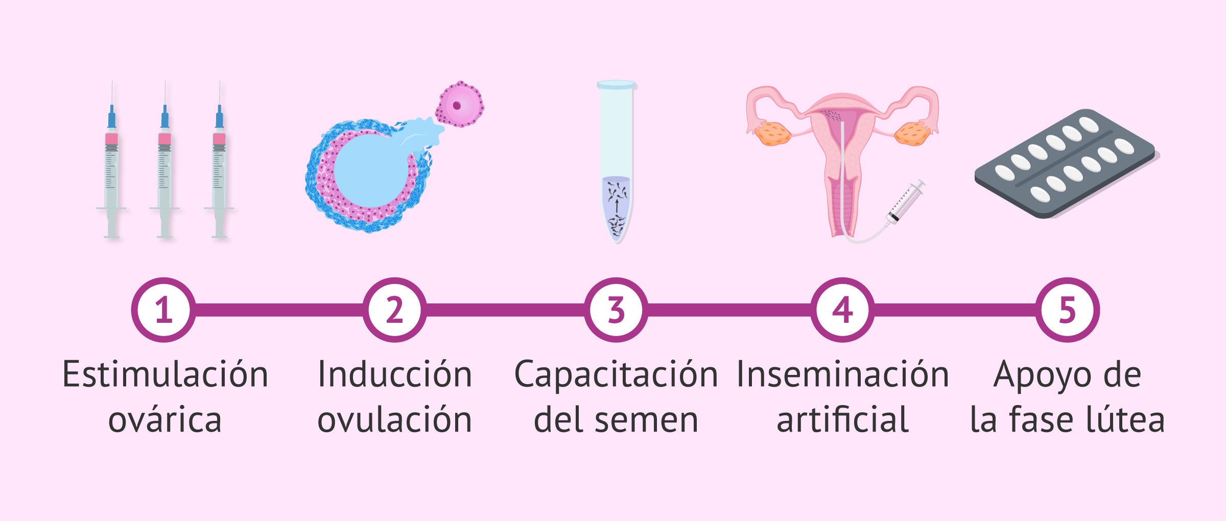 Pasos de un tratamiento con inseminación artificial (IA)