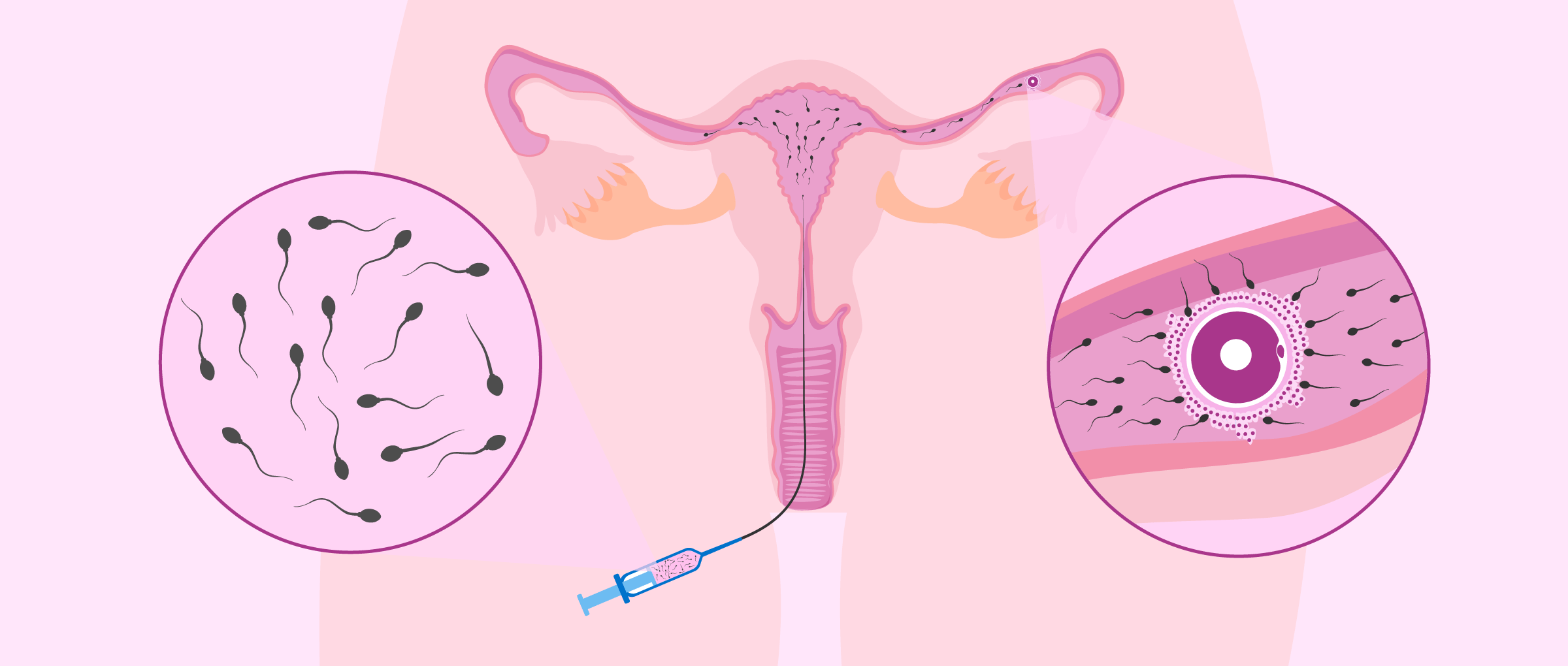 La inseminación artificial intrauterina