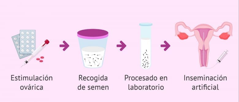 Inseminación homóloga