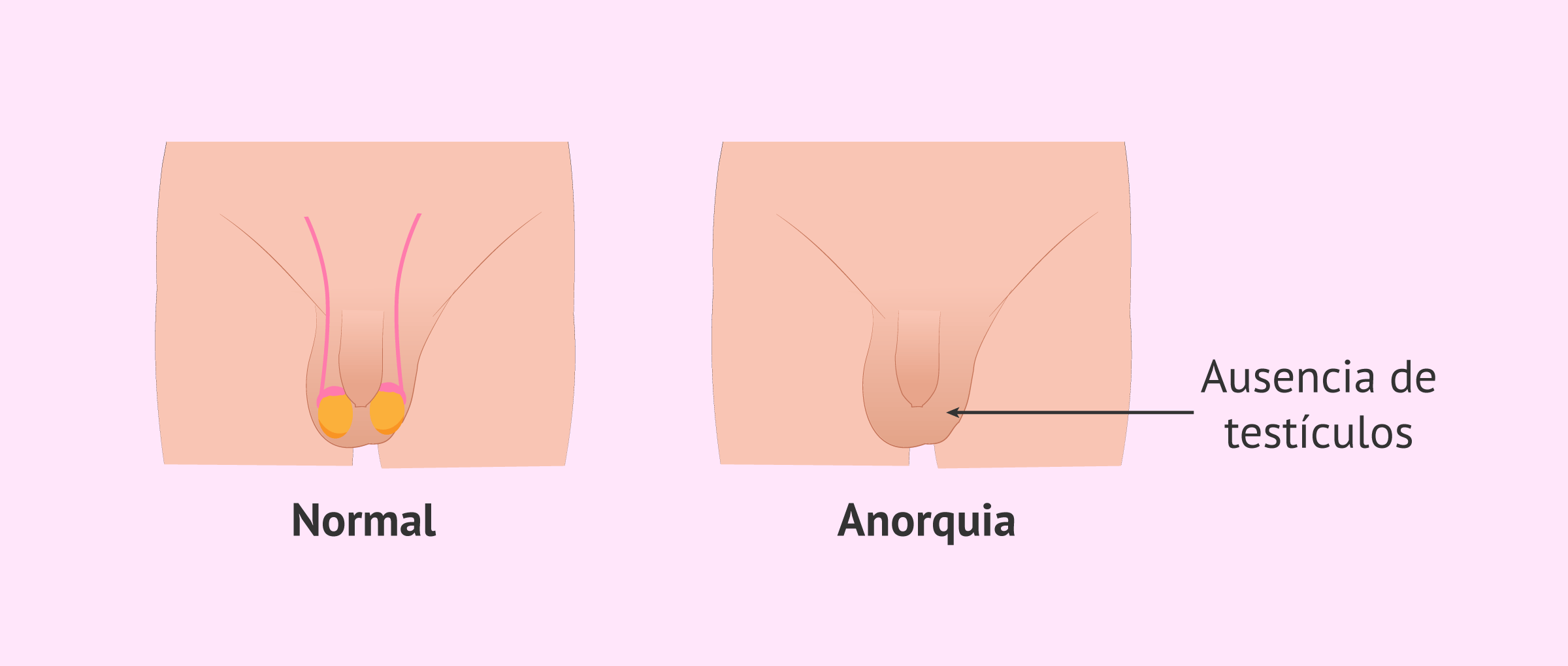 anorquia-ausencia-testiculos