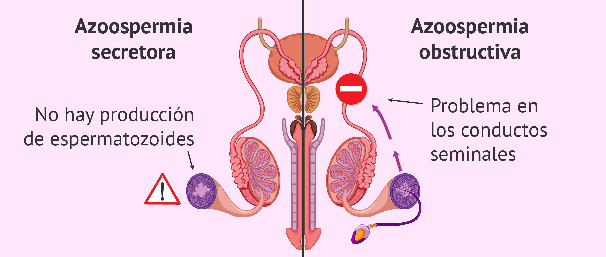 Qué es la azoospermia? - Causas, diagnóstico y tratamiento