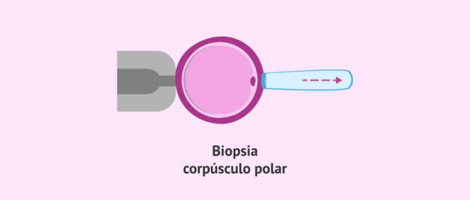 Imagen: Biopsia del corpúsculo polar