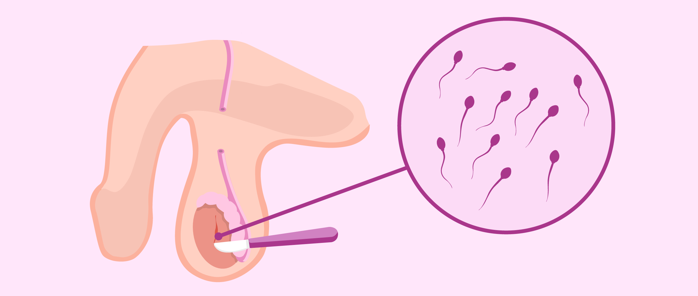 Biopsia de testículo para obtener espermatozoides