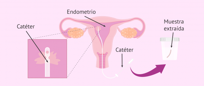 Imagen: biopsia-endometrial-defincion