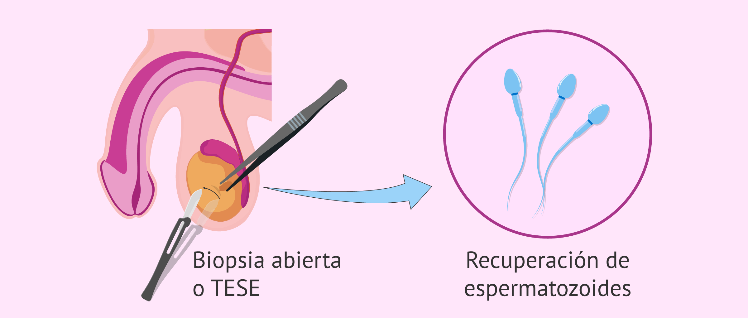 Biopsia testicular abierta (TESE)