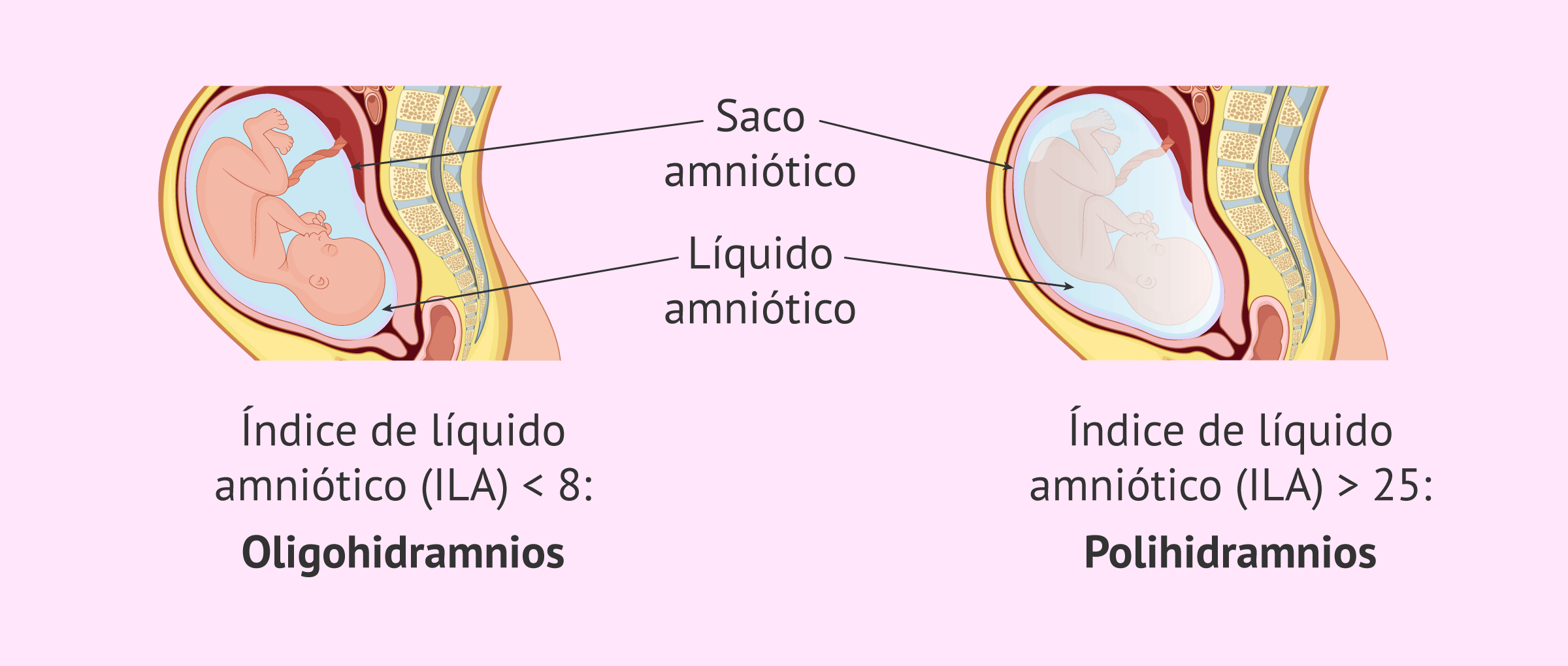 Imagen: Anomalías en la cantidad de líquido amniótico