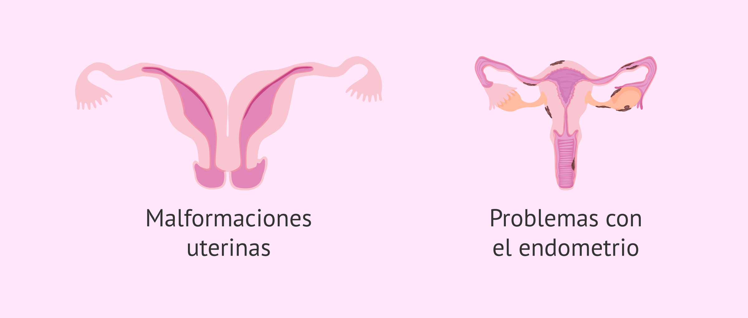 Motivos uterinos de esterilidad femenina