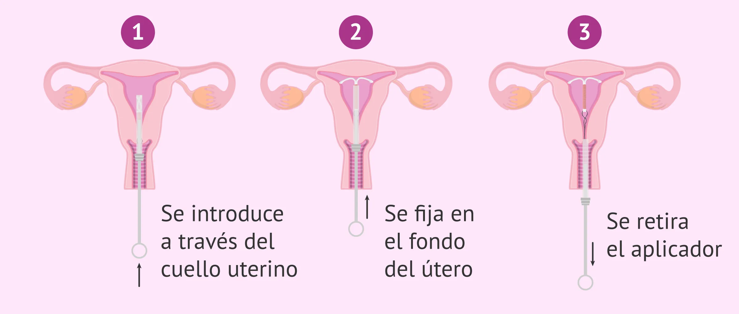 Cómo funciona el DIU? ¿Cuáles son sus ventajas y desventajas? foto imagen