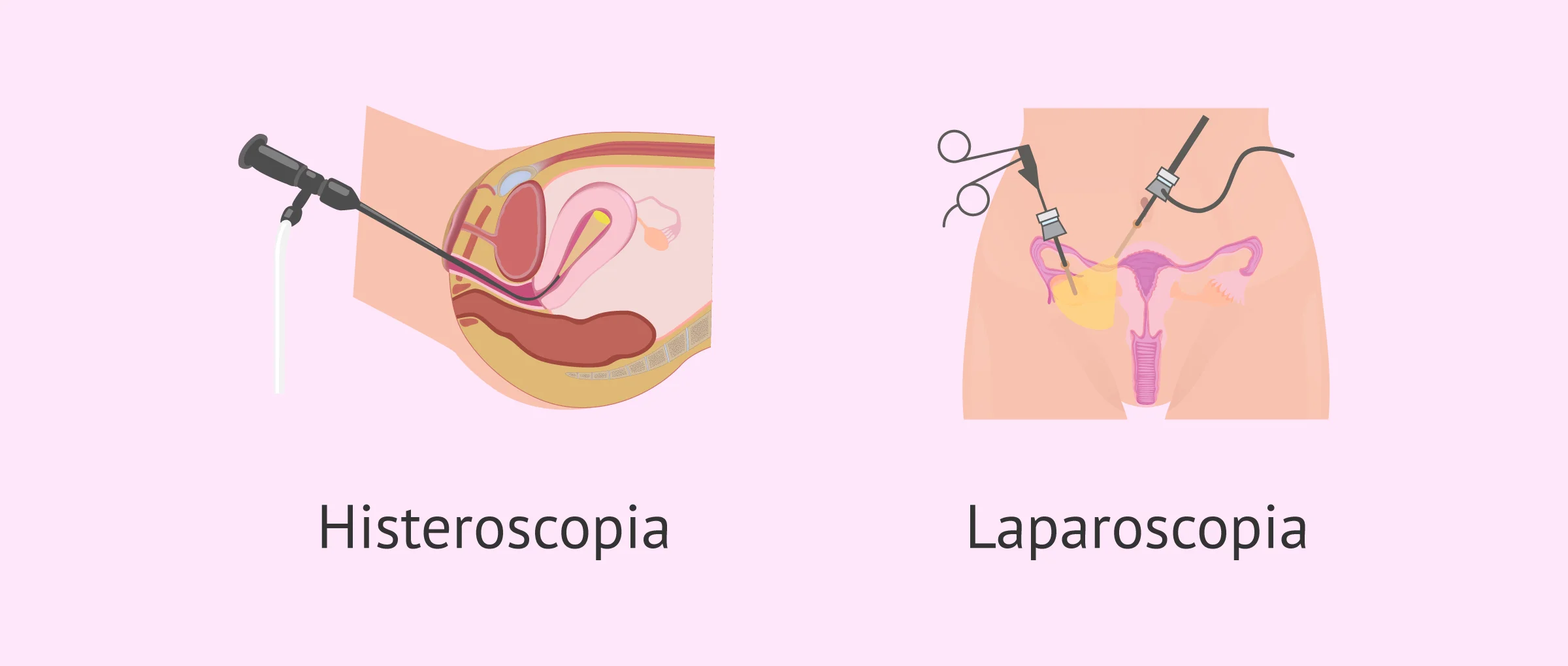 Comparación de la histeroscopia y la laparoscopia