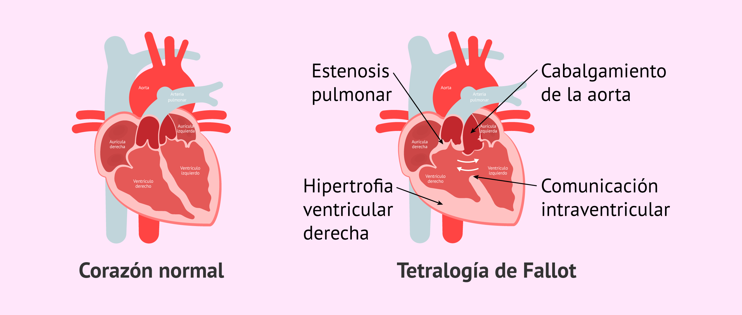 Corrección de cardiopatías
