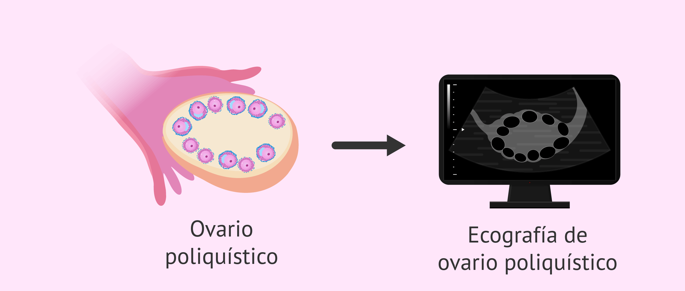 Ecografía de ovario poliquístico