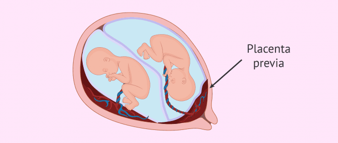 Riesgos Del Embarazo Múltiple Para La Madre Y Los Bebés
