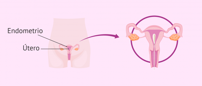 Imagen: endometrectomia-endometrio-extirpacion
