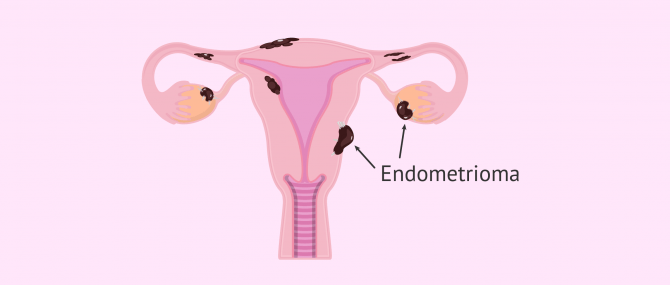 Imagen: endometrioma