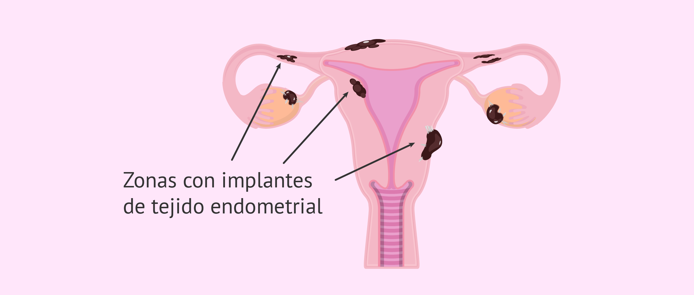 Zonas del aparato reproductor con endometriosis