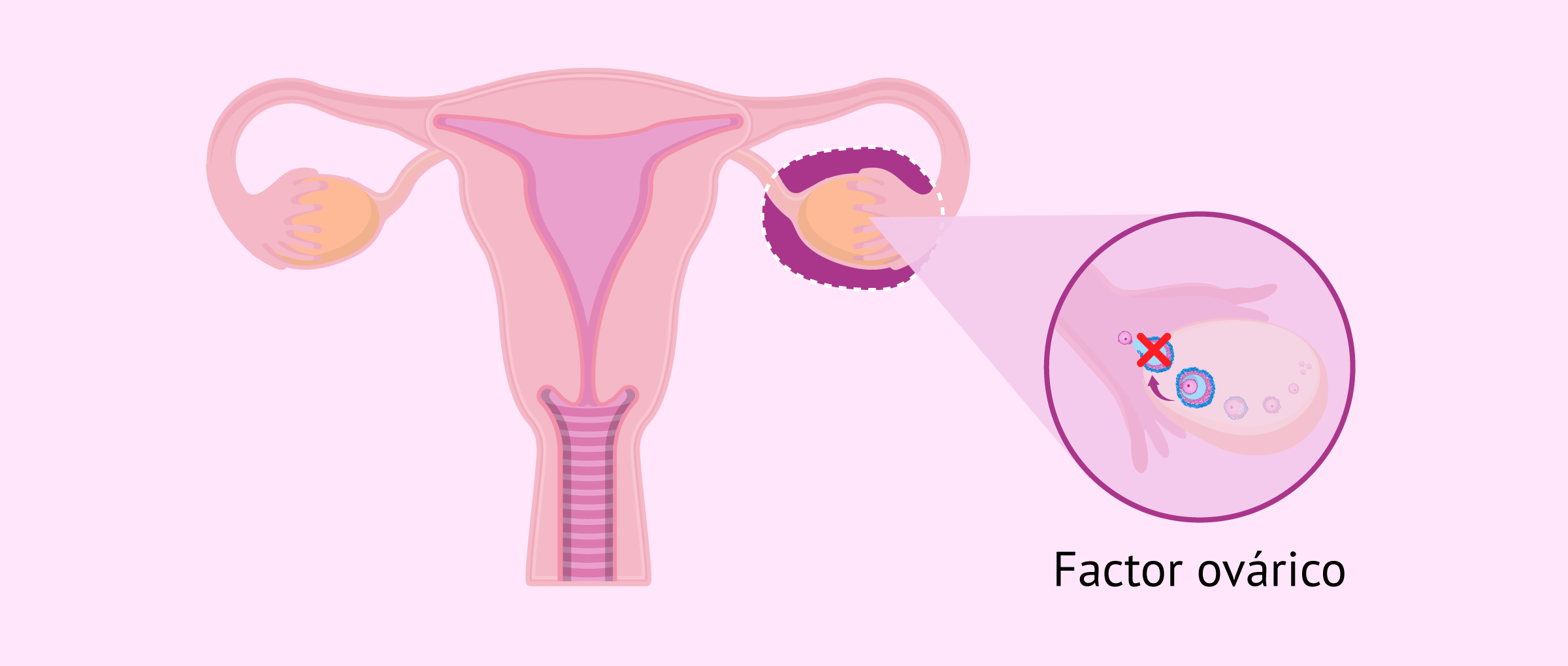 Infertilidad femenina por factor ovárico