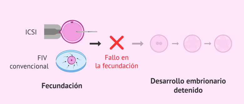 Imagen: Fallo de fecundación en reproducción asistida