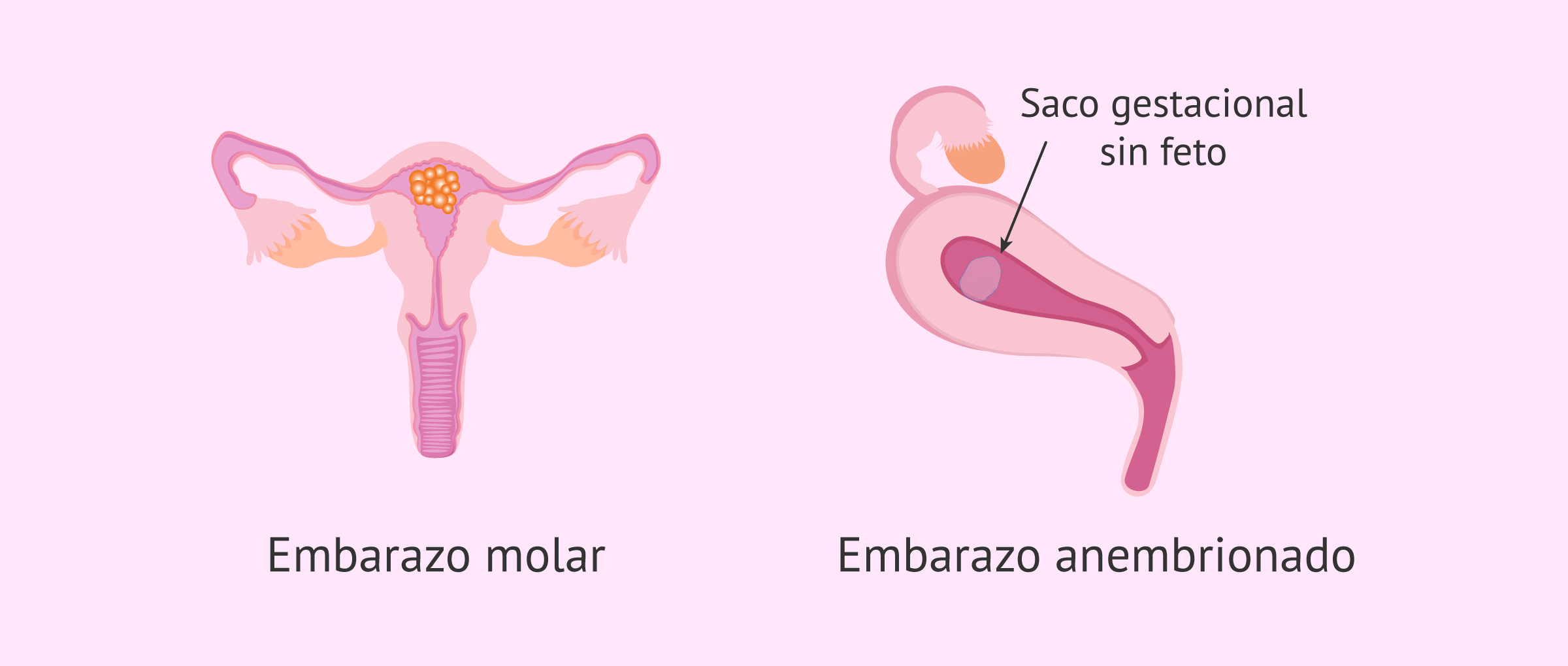 ¿Cómo se distingue un embarazo molar y anembrionario?