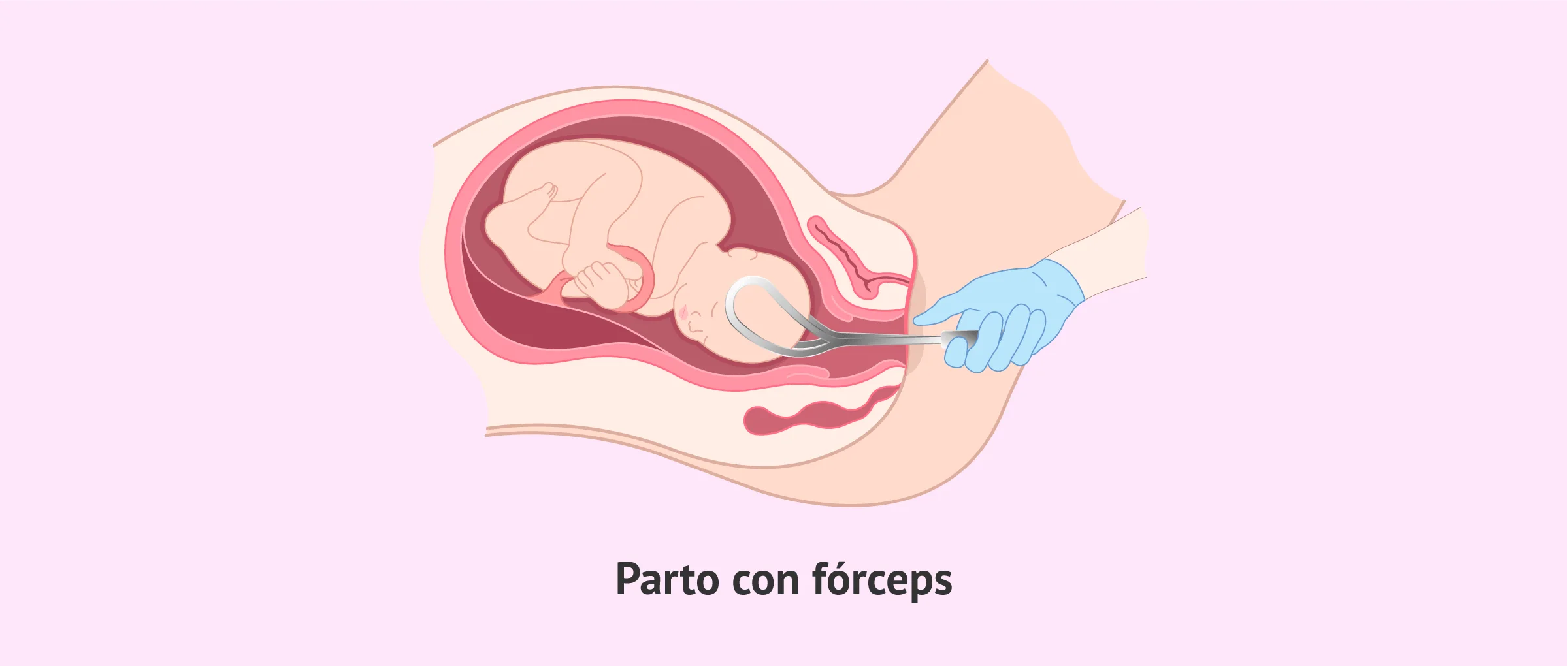 El parto con fórceps