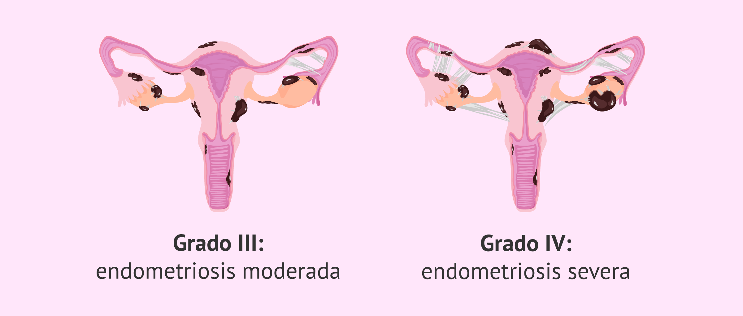 Endometriosis de grado III y IV