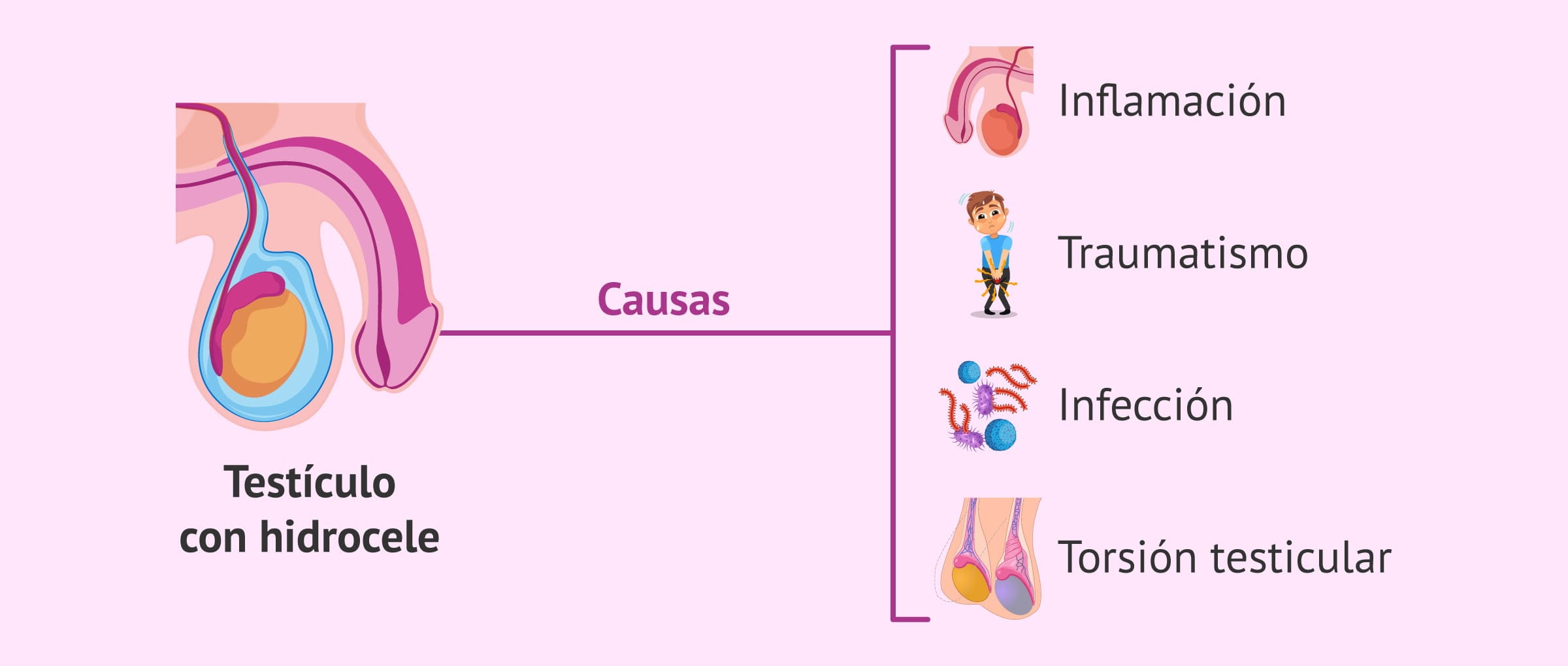 Imagen: Causas del hidrocele testicular