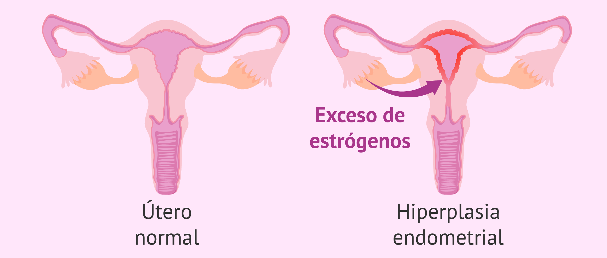 La hiperplasia endometrial