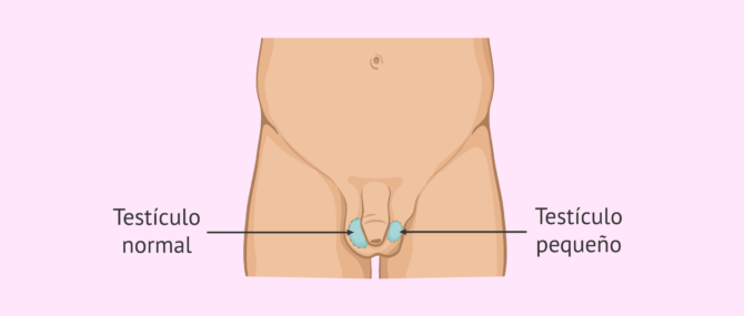 Imagen: Hipoplasia o infantilismo testicular