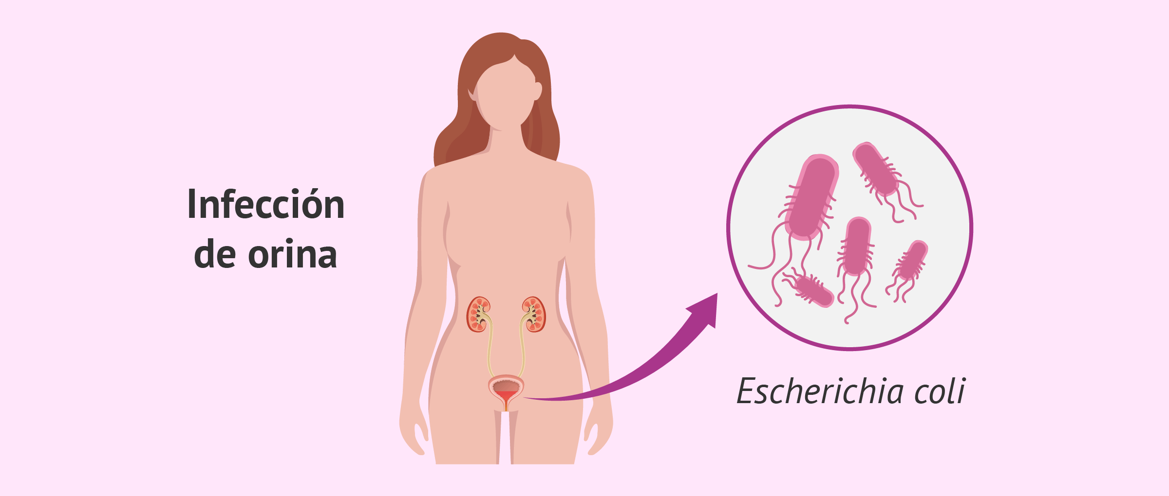 Síntomas de la Escherichia coli en orina