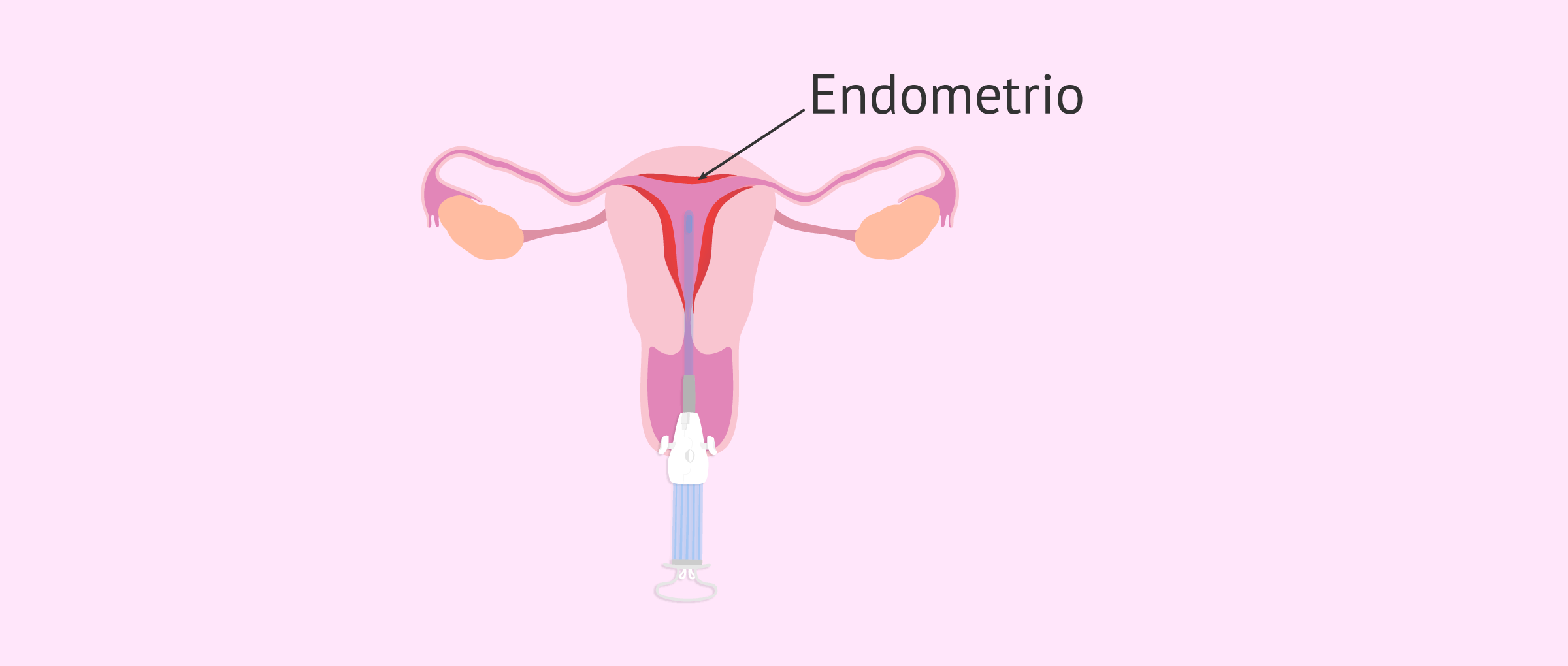 Legrado o raspado del endometrio
