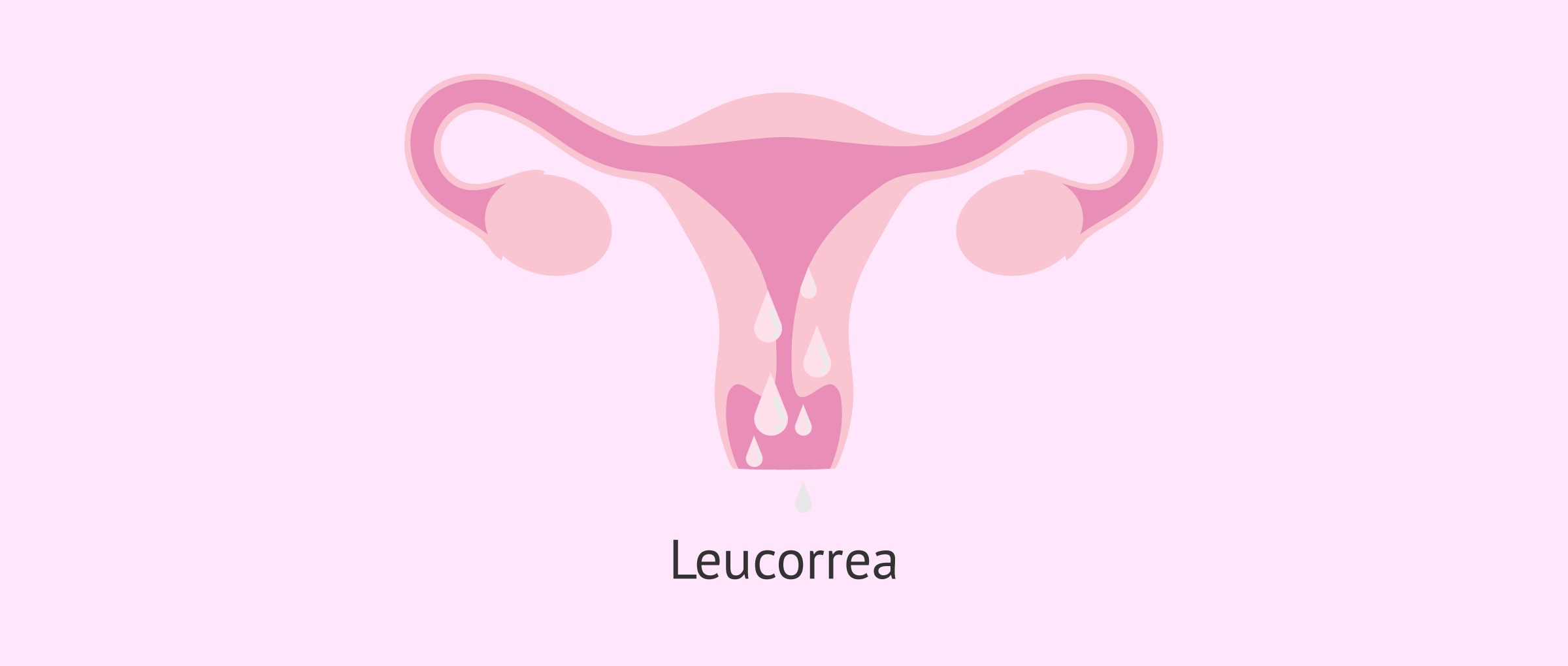 ¿Qué significa leucorrea?